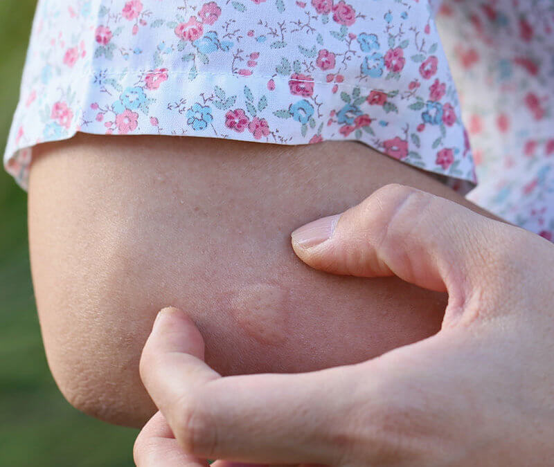 Essential Oils for Bug Bites: Caring for Your Bug Bites
